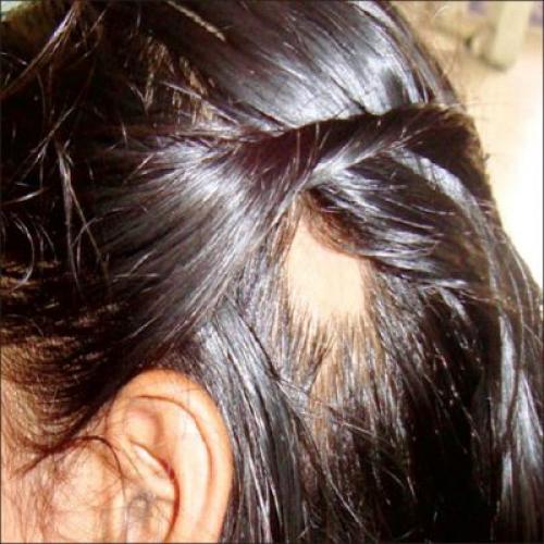 Алопеция у детей. Выявление очаговой алопеции у детей