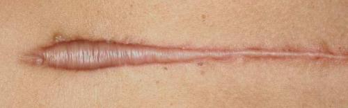 Келоидный рубец после пирсинга. Келоид что это? Келоидный рубец +Фото до и после после удаления родинки и других шрамов