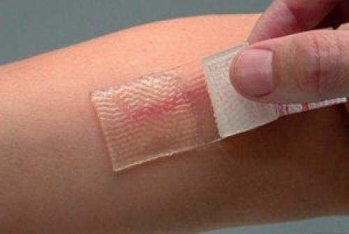 Келоидный рубец после пирсинга. Келоид что это? Келоидный рубец +Фото до и после после удаления родинки и других шрамов