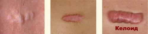 Келоидный рубец после пирсинга. Келоид что это? Келоидный рубец +Фото до и после после удаления родинки и других шрамов