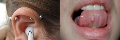 Келоидный рубец после пирсинга. Келоид что это? Келоидный рубец +Фото до и после после удаления родинки и других шрамов