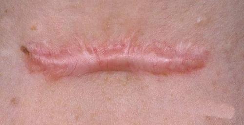 Келоидный рубец после пирсинга. Келоид что это? Келоидный рубец +Фото до и после после удаления родинки и других шрамов