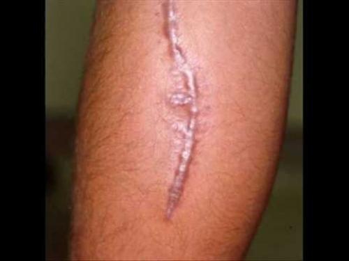 Келоидный рубец это опасно. Описание