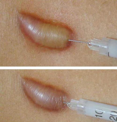 Келоидный рубец после пирсинга. Келоид что это? Келоидный рубец +Фото до и после после удаления родинки и других шрамов