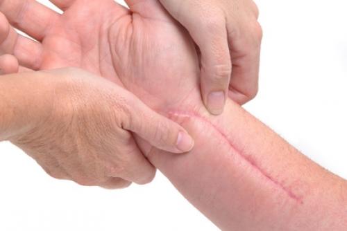 Келоидный рубец это опасно. Описание