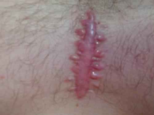 Келоидный рубец это опасно. Описание