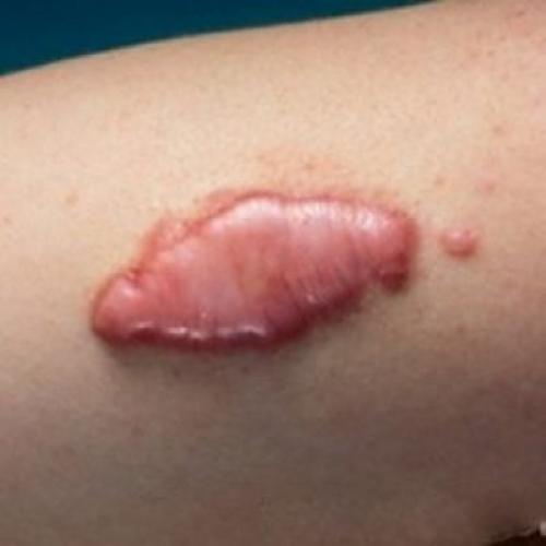 Келоидный рубец после бцж это. Келоидный рубец, фото