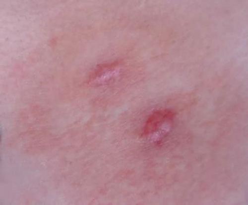 Келоидный рубец после удаления родинки. Что такое келоидный рубец