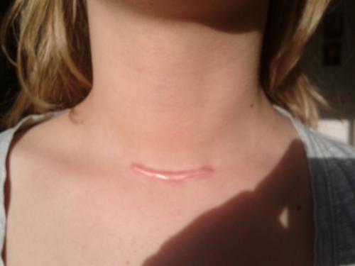 Келоидный рубец, что это. Что такое келоидные рубцы и можно ли их вылечить?