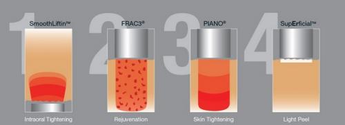 Лазер 4d для лица. Суть и результат процедуры: