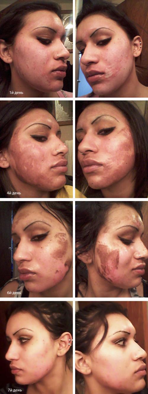 Химический пилинг с трихлоруксусной кислотой. ТСА пилинг и все, что о нем нужно знать