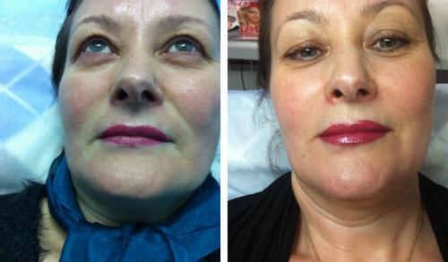 Контурная пластика губ противопоказания после процедуры. Контурная пластика лица: противопоказания, осложнения, эффект