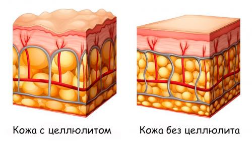 Целлюлит на ногах и попе причины появления и лечение. Первый шаг борьбы с целлюлитом — Разобраться от чего появляется целлюлит