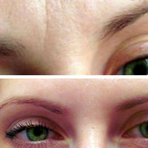 Микротоки, что это такое в косметологии. Микротоковая терапия лица