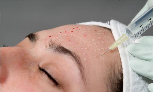 Какие процедуры для подтяжки овала лица. Обзор эффективных способов подтяжки овала лица: борьба с птозом и дряблостью кожи