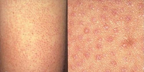 После шугаринга вросли волосы на ногах. Отзывы о том, как бороться с вросшими волосами после шугаринга