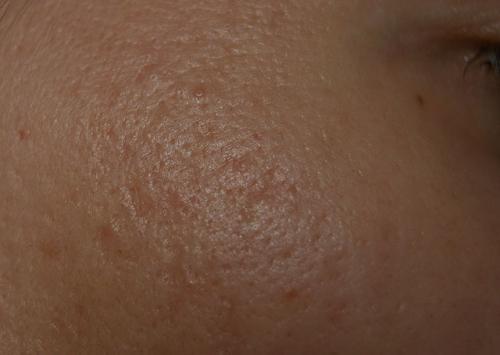 Очень расширены поры на всем лице причины и лечение. Как избавиться от расширенных пор на лице