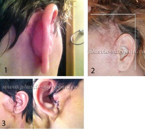 Оцените результат круговой подтяжки лица в фото до и после операции