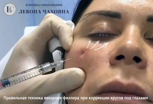 Убрать синяки под глазами с помощью инъекций. Какие препараты от кругов (синяков) под глазами можно колоть?