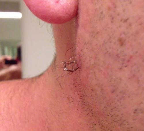 Парень использует пинцет, чтобы вытащить самый длинный вросший волос в мире из своего лица