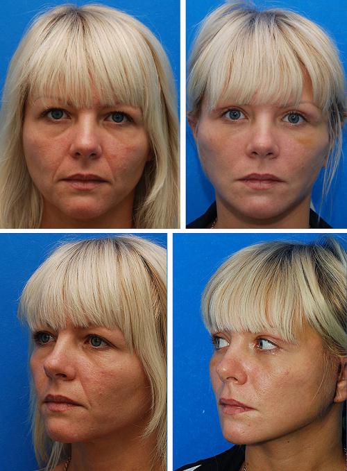 Оцените результат круговой подтяжки лица в фото до и после операции