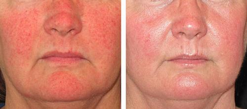 Лазер для лица в косметологии Паломар. Лазер Паломар (Рalomar) – комфортное лазерное омоложение