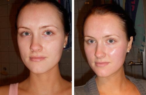 Химический пилинг с трихлоруксусной кислотой. ТСА пилинг и все, что о нем нужно знать