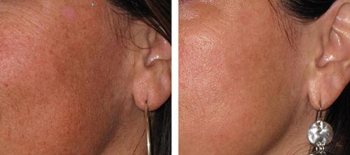 Лазер для лица в косметологии Паломар. Лазер Паломар (Рalomar) – комфортное лазерное омоложение