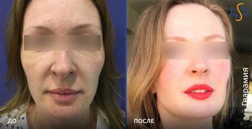 Круговая подтяжка лица, цены, пластика лица, стоимость