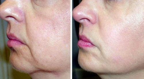 Как убрать брыли у косметолога. Брыли: как убрать обвисшие щеки. Косметология, упражнения и пластика