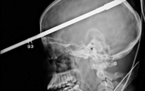 Парень использует пинцет, чтобы вытащить самый длинный вросший волос в мире из своего лица