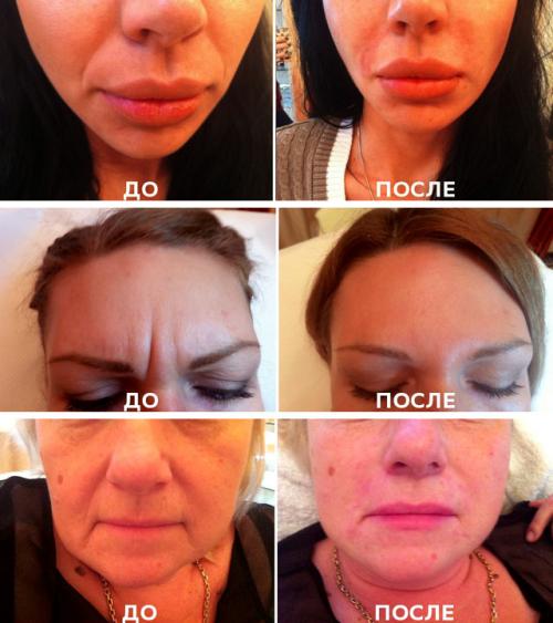 Контурная пластика губ противопоказания после процедуры. Контурная пластика лица: противопоказания, осложнения, эффект