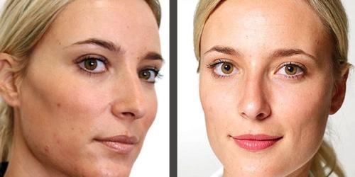 Молочная кислота для лица. Показания