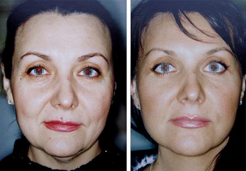 Оцените результат круговой подтяжки лица в фото до и после операции