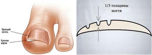 Пластины для коррекции вросшего ногтя в домашних условиях. Вросший ноготь: как лечить в домашних условиях