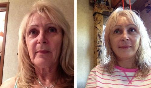 Оцените результат круговой подтяжки лица в фото до и после операции