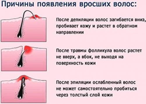 Как избавиться от вросших волос. Почему врастают волосы?