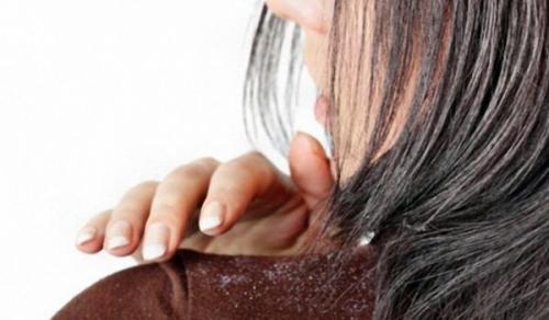 Яичная маска для волос от перхоти. Маска для волос от перхоти дома: как подобрать