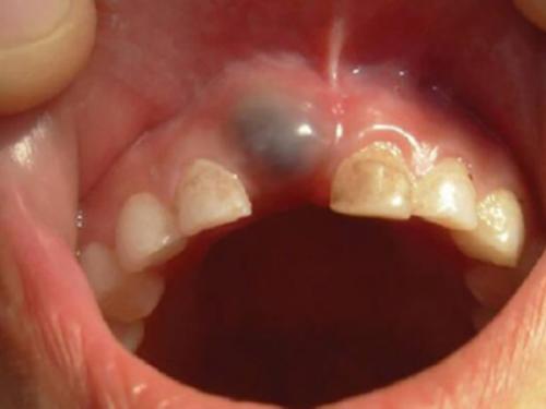 Противоотечные препараты для лица после удаления зуба. Когда отек – повод для визита к врачу