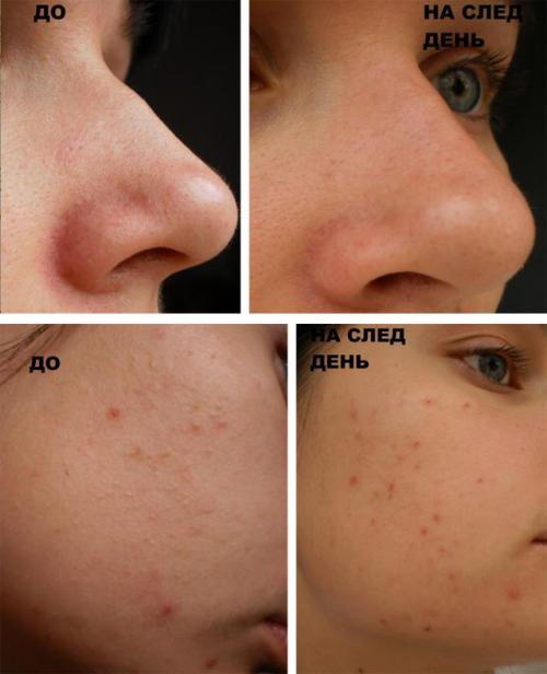 Мануальная чистка лица – единственный способ избавиться от камедонов и забитых пор