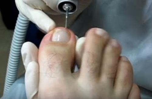 Больно ли удалять вросший ноготь на ноге