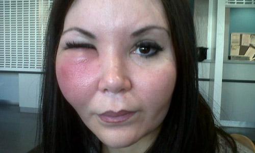 Осложнения после введения филлеров в скулы. Причины появления отеков после филлеров в скулы