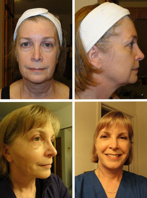 Оцените результат круговой подтяжки лица в фото до и после операции