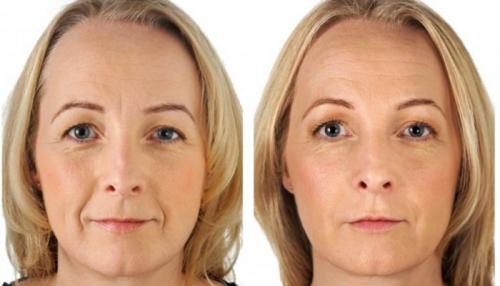 Упражнения на удаление носогубных складок. Носогубные складки — как убрать