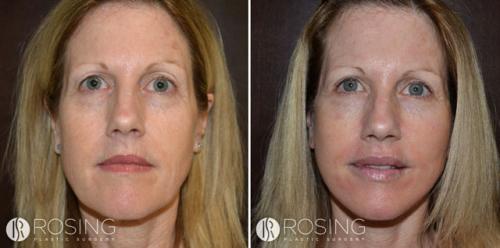 Химический пилинг с трихлоруксусной кислотой. ТСА пилинг и все, что о нем нужно знать