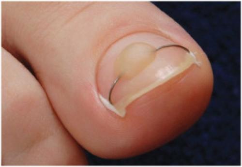 Коррекция ногтевой пластины. Способы коррекции