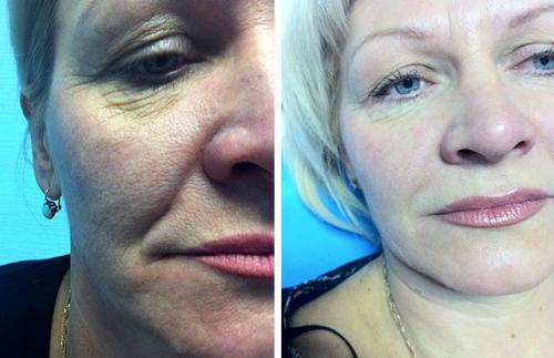 Контурная пластика губ противопоказания после процедуры. Контурная пластика лица: противопоказания, осложнения, эффект