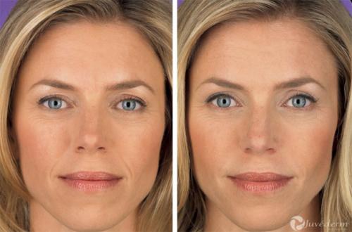 Контурная пластика губ противопоказания после процедуры. Контурная пластика лица: противопоказания, осложнения, эффект