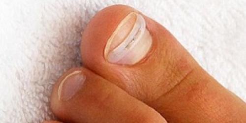 Коррекция вросшего ногтя пластинами в домашних условиях. Как безболезненно выполнить лечение вросшего ногтя народными средствами