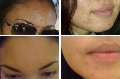 Мануальная чистка лица – единственный способ избавиться от камедонов и забитых пор